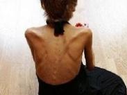 小兒神經性厭食