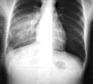 急性嗜酸性粒細胞性肺炎