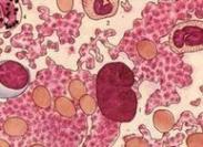 原發(fā)性血小板增多癥