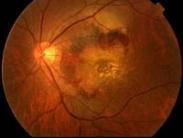 糖尿病性視網膜病變