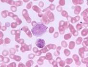 嗜酸性細胞增多癥