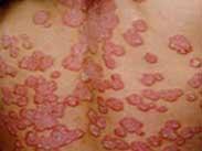 遲發性皮膚卟啉病