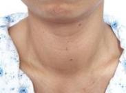 老年人甲狀腺功能亢進危象