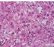 類固醇5α-還原酶2缺乏綜合征