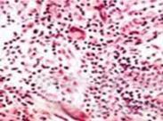 迪格奧爾格綜合征