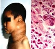 血管免疫母細胞性淋巴結病