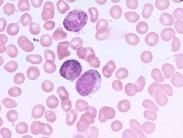 小兒成人型慢性粒細胞白血病