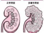 繼發性腎臟疾病