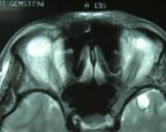 老年人夏伊-德雷格綜合征