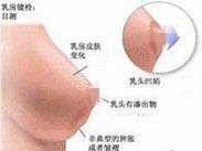 閉經(jīng)溢乳綜合征