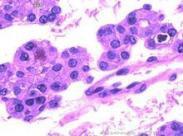 高碘性甲狀腺腫