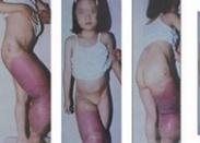 小兒血管-骨肥大綜合征