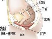 膀胱脫垂