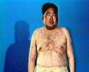 腎上腺髓質功能亢進