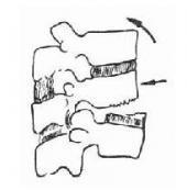 髂骨取骨后盆側(cè)腹壁疝