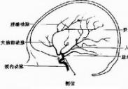 外傷后頸內動脈閉塞