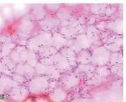 間充質軟骨肉瘤