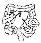 乙狀結(jié)腸間疝