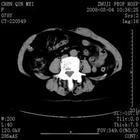 腹直肌鞘內血腫
