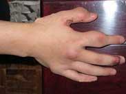 幼年型類風濕性關節炎