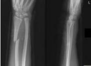 先天性遠端尺橈關節半脫位