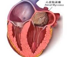 心臟粘液瘤