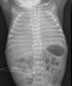 出血性休克和腦病綜合征