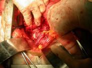 老年人主動脈夾層分離