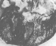 老年性心瓣膜病