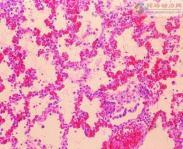 肺泡-毛細血管阻滯綜合征