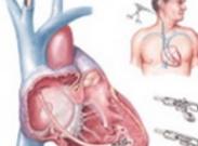 小兒病毒性心肌炎